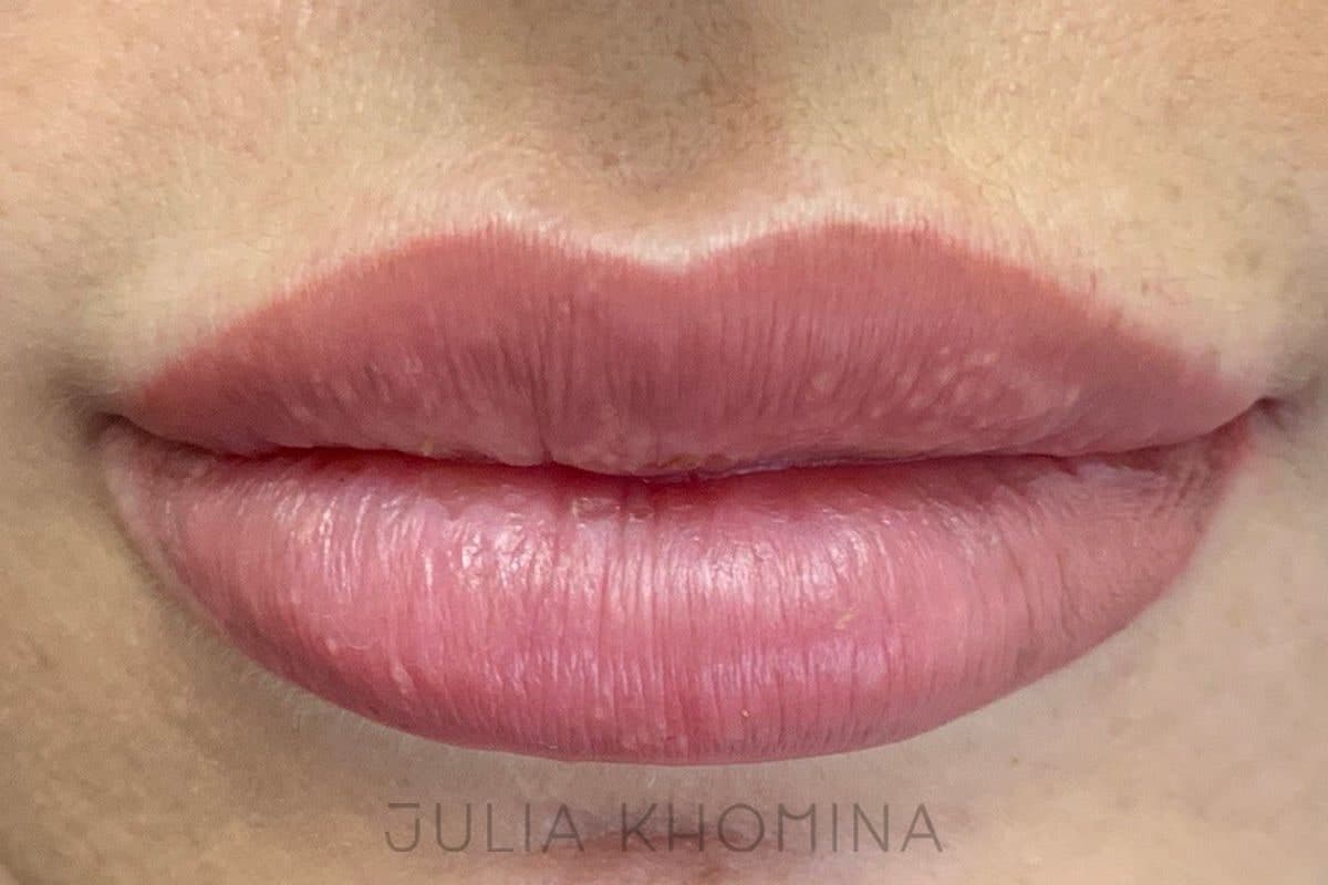 Maquillage permanent des lèvres — après