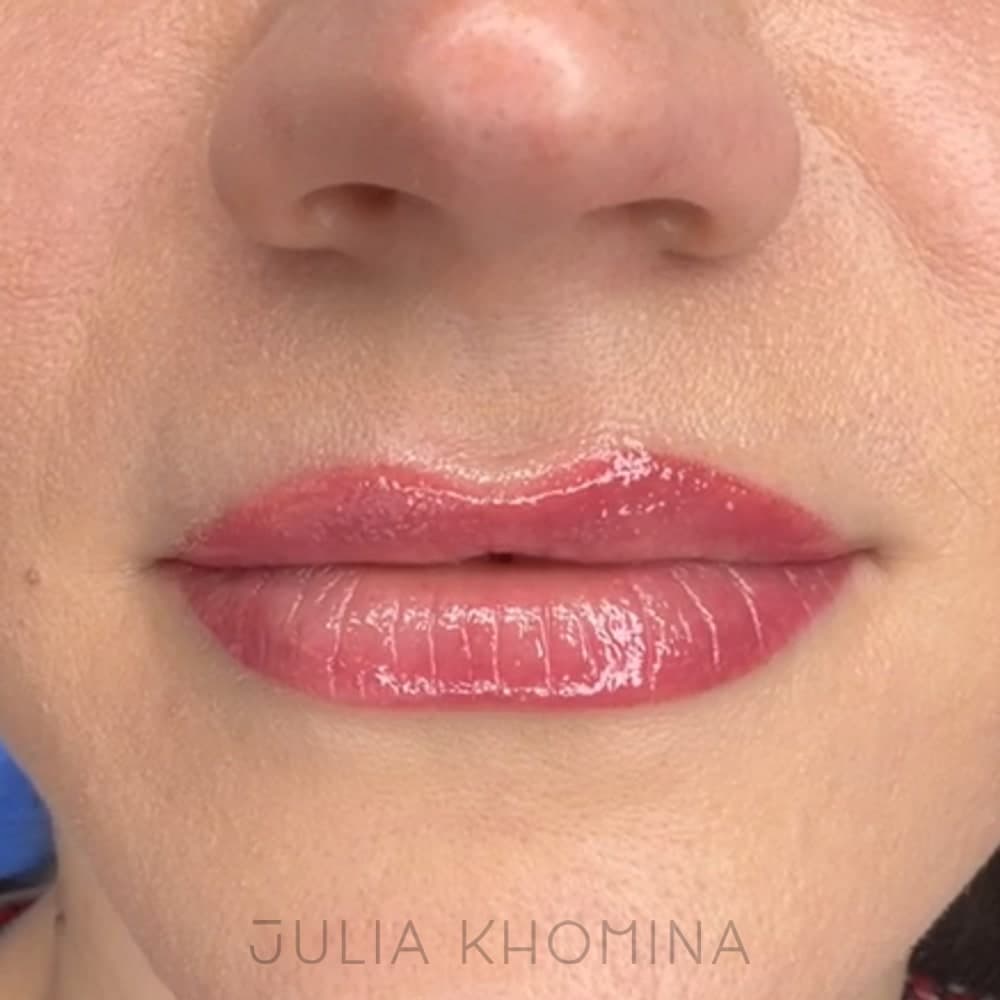 Maquillage permanent des lèvres — après