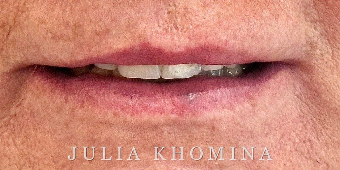 Maquillage permanent des lèvres — avant