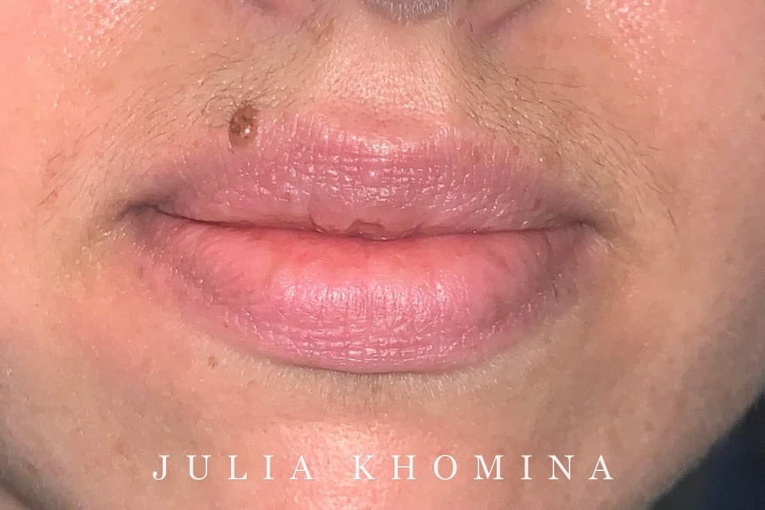 Maquillage permanent des lèvres — avant