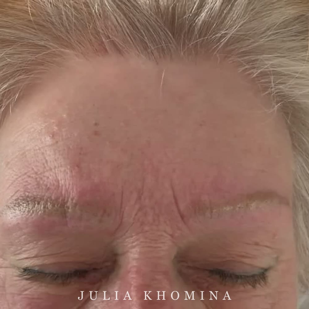 Sourcils après plusieurs séances de détatouage au remover