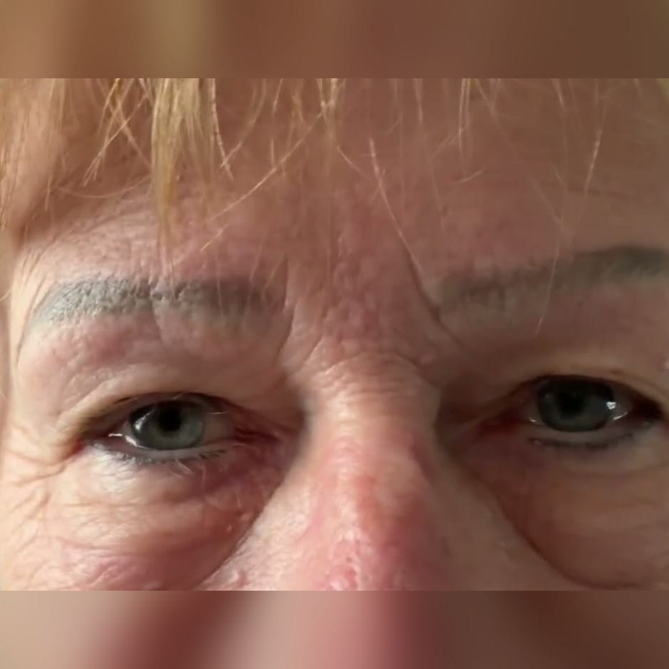 Ancien maquillage permanent des sourcils ayant viré au gris-bleu